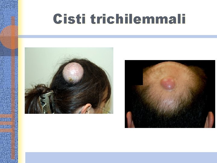 Cisti trichilemmali 