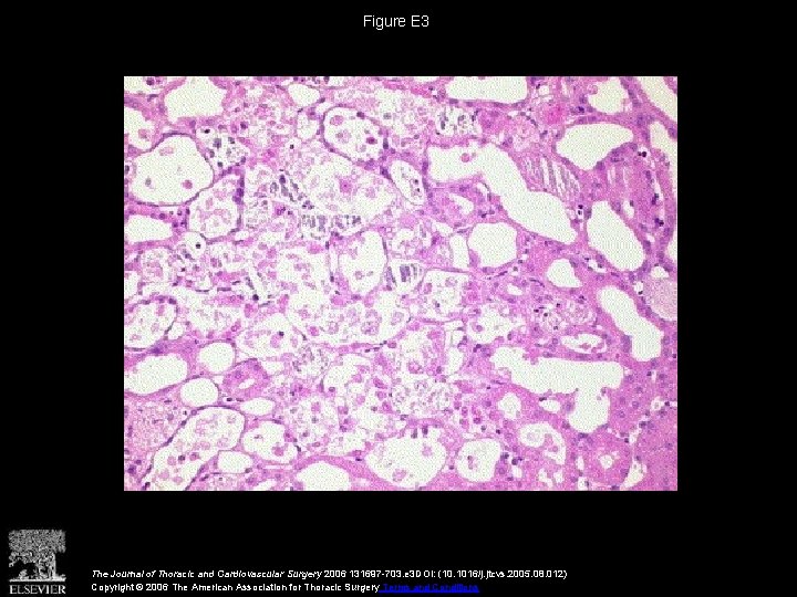 Figure E 3 The Journal of Thoracic and Cardiovascular Surgery 2006 131697 -703. e