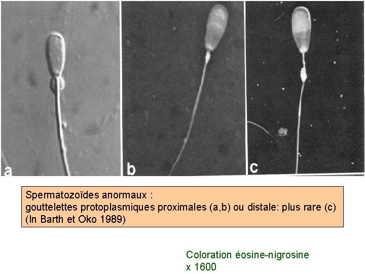 Spermatozoïdes anormaux : gouttelettes protoplasmiques proximales (a, b) ou distale: plus rare (c) (In