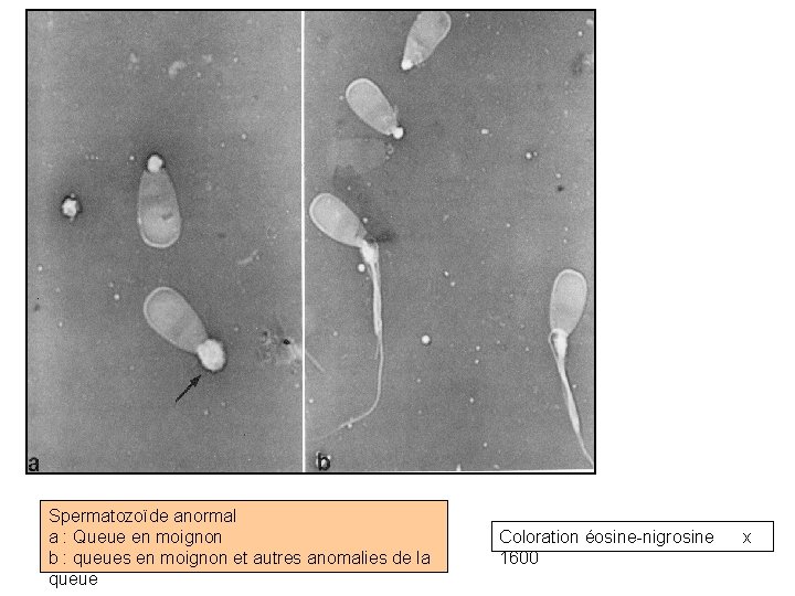 Spermatozoïde anormal a : Queue en moignon b : queues en moignon et autres