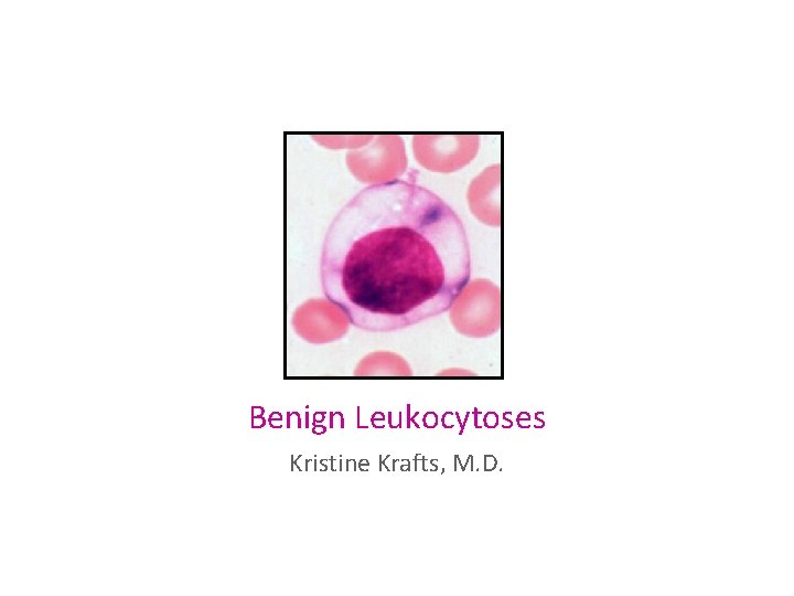 Benign Leukocytoses Kristine Krafts, M. D. 