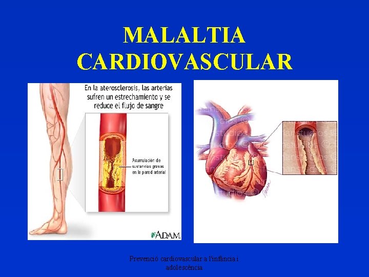 MALALTIA CARDIOVASCULAR Prevenció cardiovascular a l'infància i adolescència 