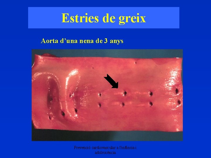 Estries de greix Aorta d’una nena de 3 anys Prevenció cardiovascular a l'infància i