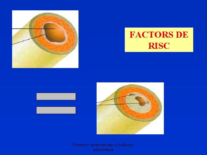 FACTORS DE RISC Prevenció cardiovascular a l'infància i adolescència 