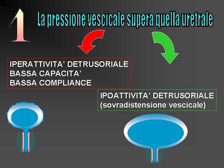 IPERATTIVITA’ DETRUSORIALE BASSA CAPACITA’ BASSA COMPLIANCE IPOATTIVITA’ DETRUSORIALE (sovradistensione vescicale) 