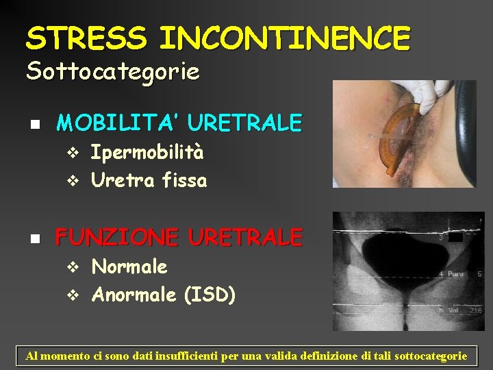 STRESS INCONTINENCE Sottocategorie n MOBILITA’ URETRALE Ipermobilità v Uretra fissa v n FUNZIONE URETRALE