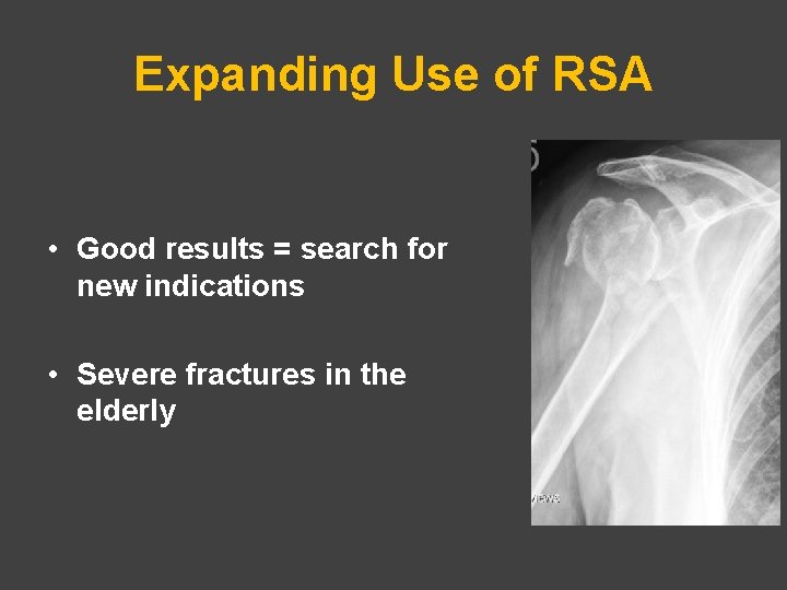 Expanding Use of RSA • Good results = search for new indications • Severe