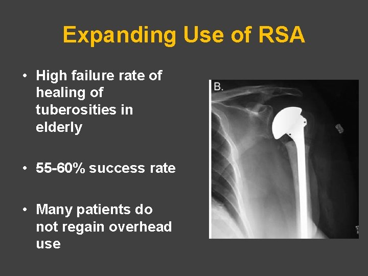 Expanding Use of RSA • High failure rate of healing of tuberosities in elderly