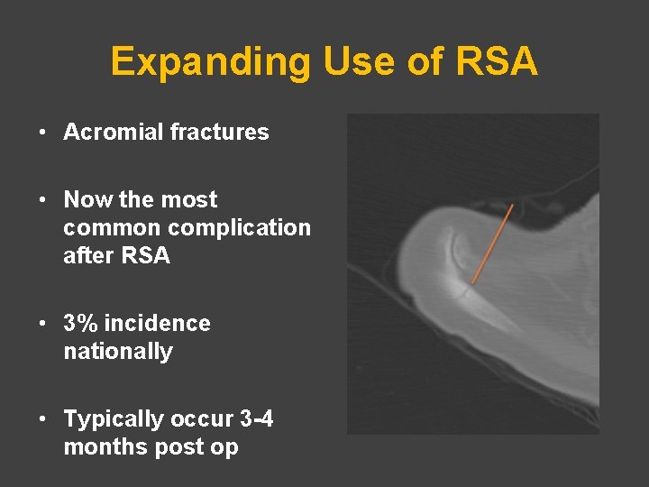 Expanding Use of RSA • Acromial fractures • Now the most common complication after