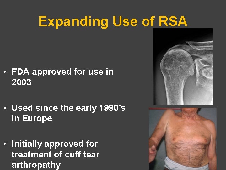 Expanding Use of RSA • FDA approved for use in 2003 • Used since