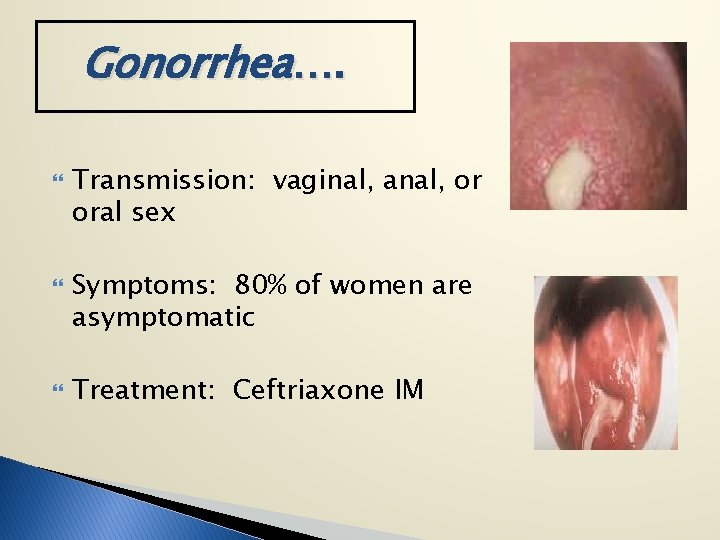 Gonorrhea…. Transmission: vaginal, anal, or oral sex Symptoms: 80% of women are asymptomatic Treatment: