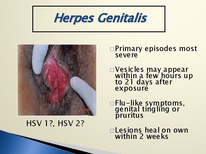 Herpes Genitalis � Primary severe episodes most � Vesicles may appear within a few