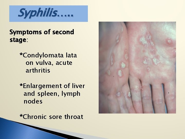 Syphilis…. . Symptoms of second stage: *Condylomata lata on vulva, acute arthritis *Enlargement of