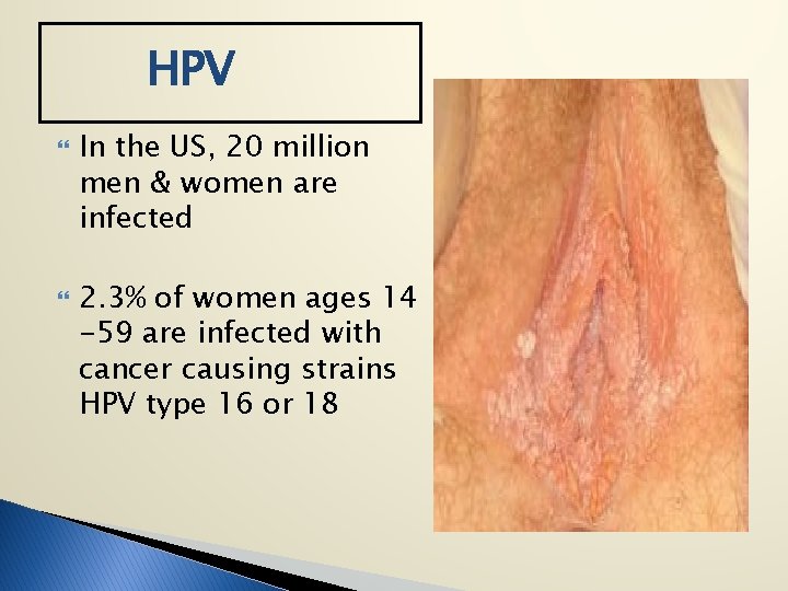 HPV In the US, 20 million men & women are infected 2. 3% of