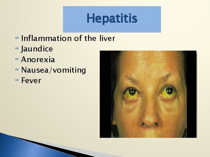 Hepatitis Inflammation of the liver Jaundice Anorexia Nausea/vomiting Fever 