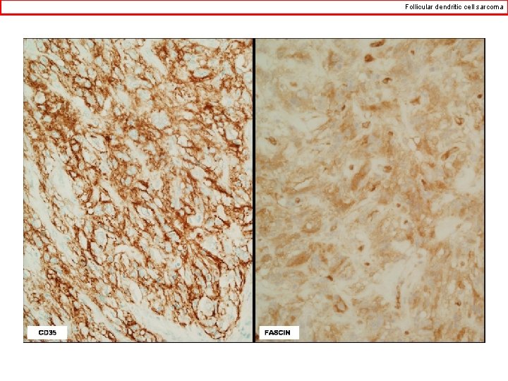 Follicular dendritic cell sarcoma 