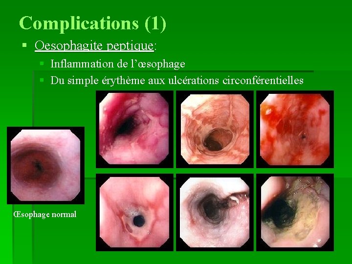 Complications (1) § Oesophagite peptique: § Inflammation de l’œsophage § Du simple érythème aux