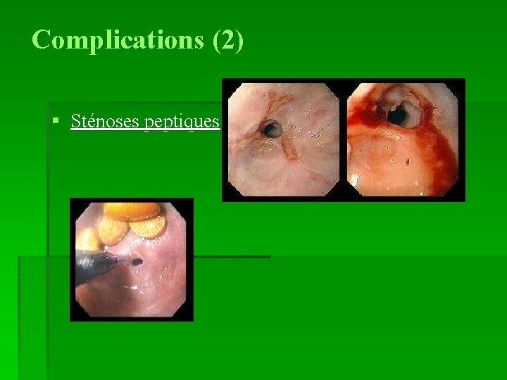 Complications (2) § Sténoses peptiques 