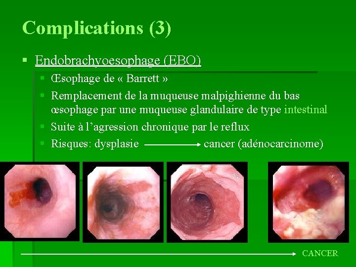 Complications (3) § Endobrachyoesophage (EBO) § Œsophage de « Barrett » § Remplacement de
