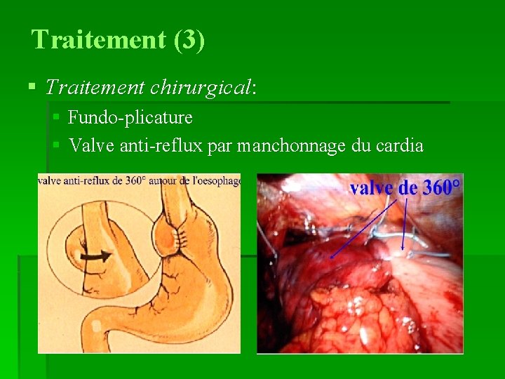 Traitement (3) § Traitement chirurgical: § Fundo-plicature § Valve anti-reflux par manchonnage du cardia