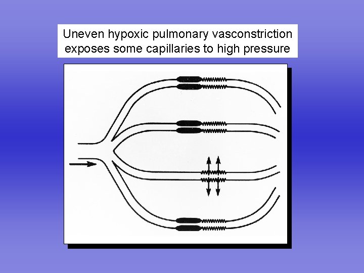 Uneven hypoxic pulmonary vasconstriction exposes some capillaries to high pressure 