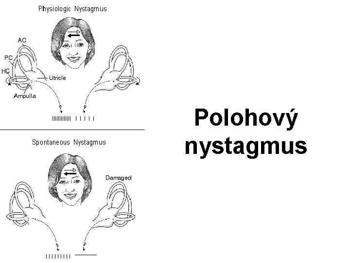 Polohový nystagmus 