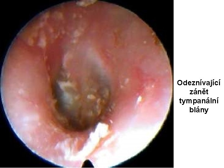 Odeznívající zánět tympanální blány 
