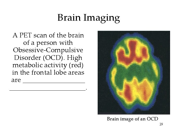 Brain Imaging A PET scan of the brain of a person with Obsessive-Compulsive Disorder