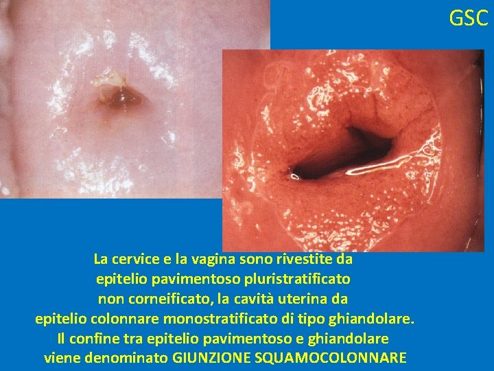 GSC La cervice e la vagina sono rivestite da epitelio pavimentoso pluristratificato non corneificato,