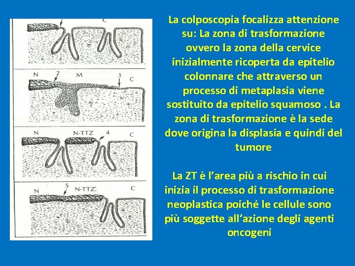 La colposcopia focalizza attenzione su: La zona di trasformazione ovvero la zona della cervice