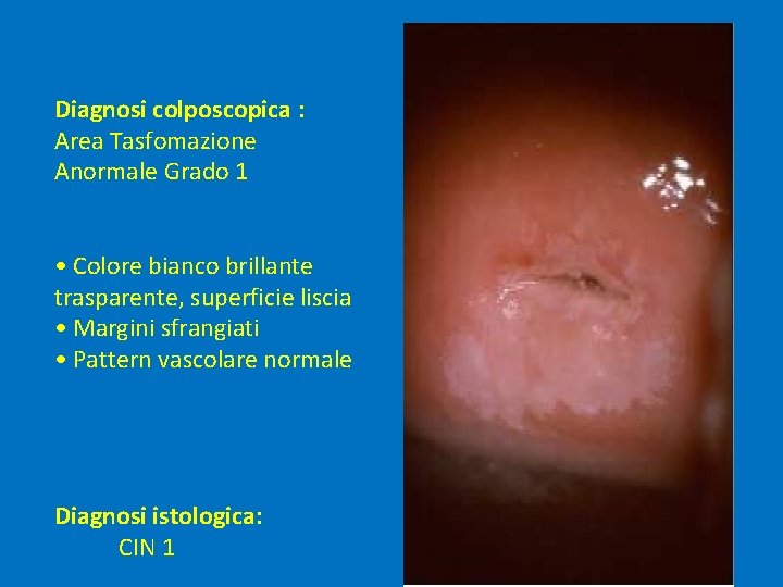 Diagnosi colposcopica : Area Tasfomazione Anormale Grado 1 • Colore bianco brillante trasparente, superficie