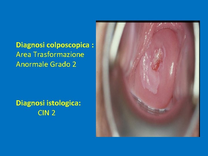 Diagnosi colposcopica : Area Trasformazione Anormale Grado 2 Diagnosi istologica: CIN 2 