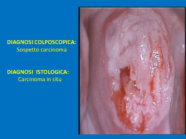 DIAGNOSI COLPOSCOPICA: Sospetto carcinoma DIAGNOSI ISTOLOGICA: Carcinoma in situ 