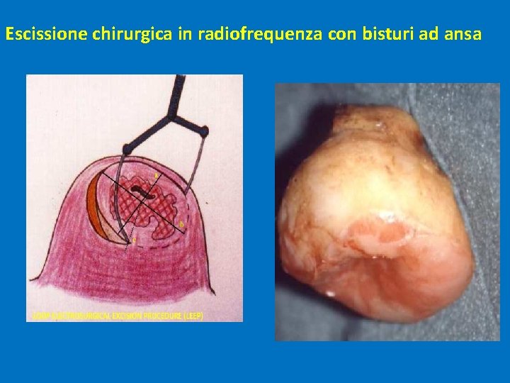 Escissione chirurgica in radiofrequenza con bisturi ad ansa 