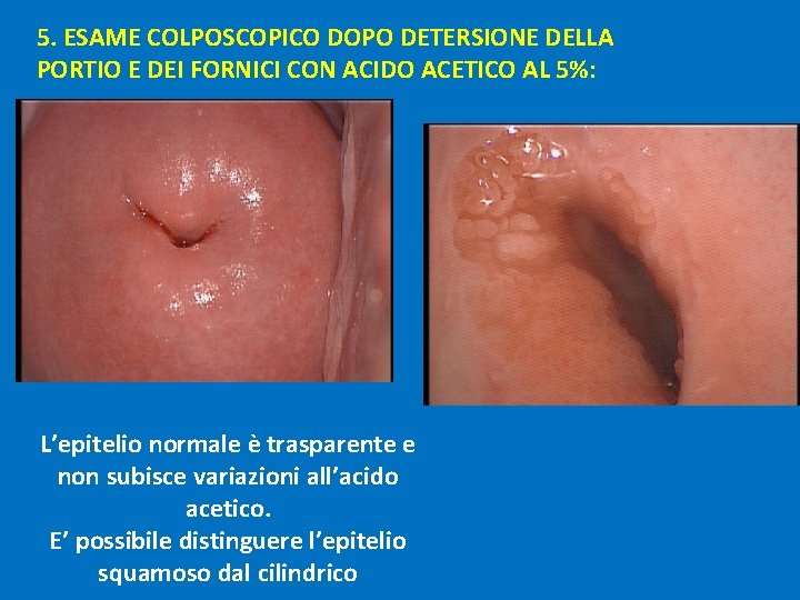 5. ESAME COLPOSCOPICO DOPO DETERSIONE DELLA PORTIO E DEI FORNICI CON ACIDO ACETICO AL