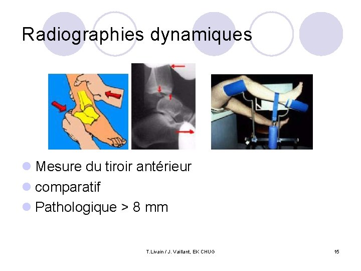 Radiographies dynamiques l Mesure du tiroir antérieur l comparatif l Pathologique > 8 mm