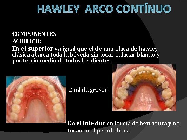 HAWLEY ARCO CONTÍNUO COMPONENTES ACRILICO: En el superior va igual que el de una