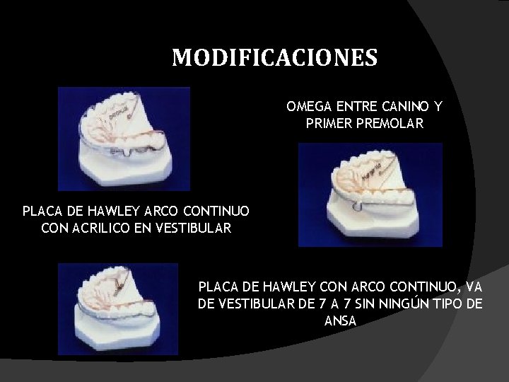 MODIFICACIONES OMEGA ENTRE CANINO Y PRIMER PREMOLAR PLACA DE HAWLEY ARCO CONTINUO CON ACRILICO