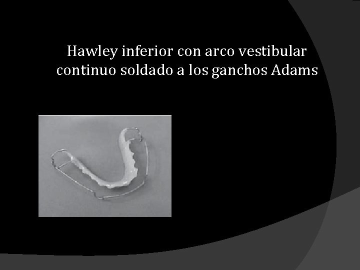 Hawley inferior con arco vestibular continuo soldado a los ganchos Adams 