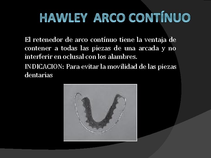 HAWLEY ARCO CONTÍNUO El retenedor de arco contínuo tiene la ventaja de contener a