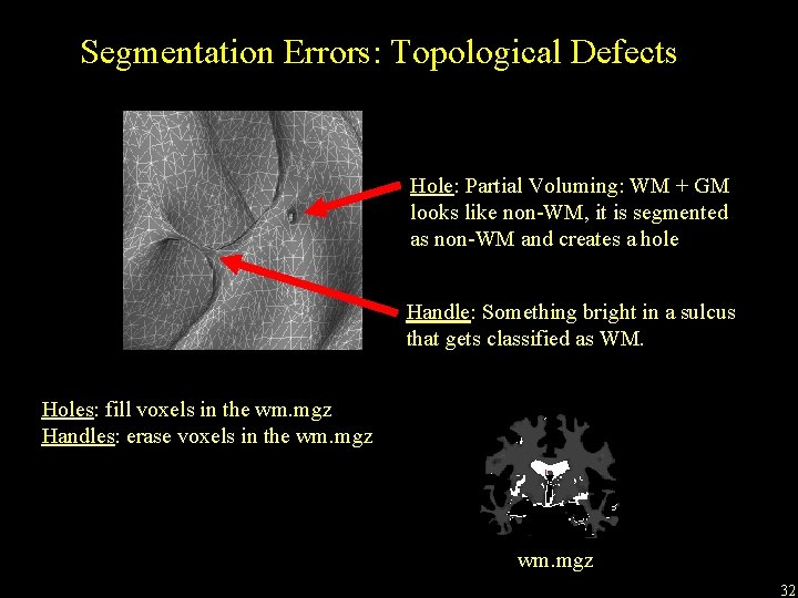 Segmentation Errors: Topological Defects Hole: Partial Voluming: WM + GM looks like non-WM, it