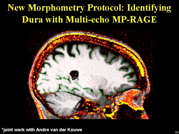 New Morphometry Protocol: Identifying Dura with Multi-echo MP-RAGE *joint work with Andre van der
