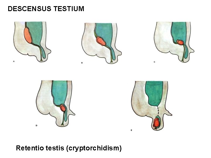 DESCENSUS TESTIUM Retentio testis (cryptorchidism) 
