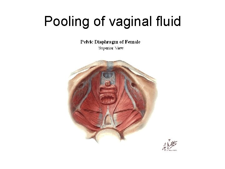 Pooling of vaginal fluid Pooling of vaginal fluid
