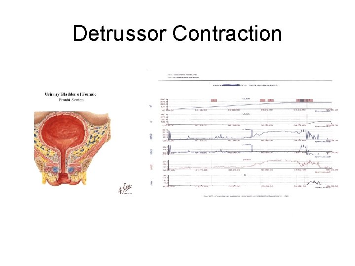 Detrussor Contraction Detrussor Contraction