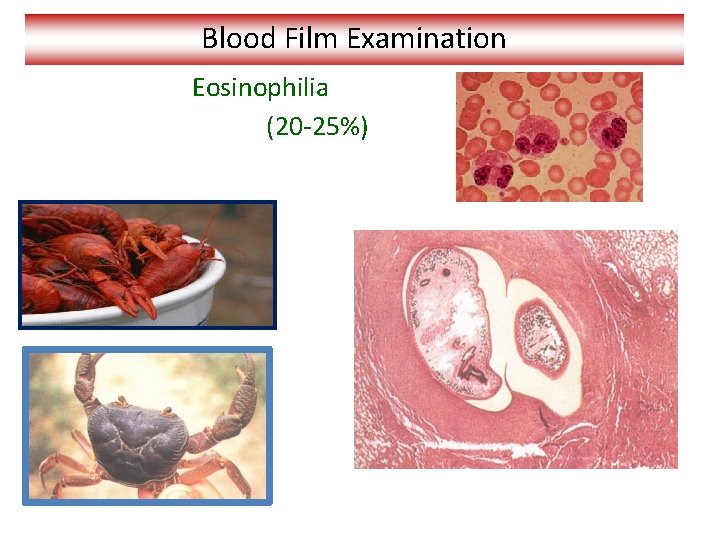 Blood Film Examination Eosinophilia (20 -25%) 