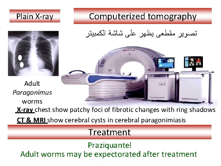 Plain X-ray Computerized tomography ﺗﺼﻮﻳﺮ ﻣﻘﻄﻌﻰ ﻳﻈﻬﺮ ﻋﻠﻰ ﺷﺎﺷﺔ ﺍﻟﻜﻤﺒﻴﺘﺮ Adult Paragonimus worms X-ray