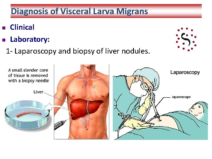 Diagnosis of Visceral Larva Migrans Clinical n Laboratory: 1 - Laparoscopy and biopsy of