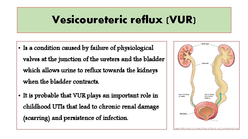 Vesicoureteric reflux (VUR) • Is a condition caused by failure of physiological valves at