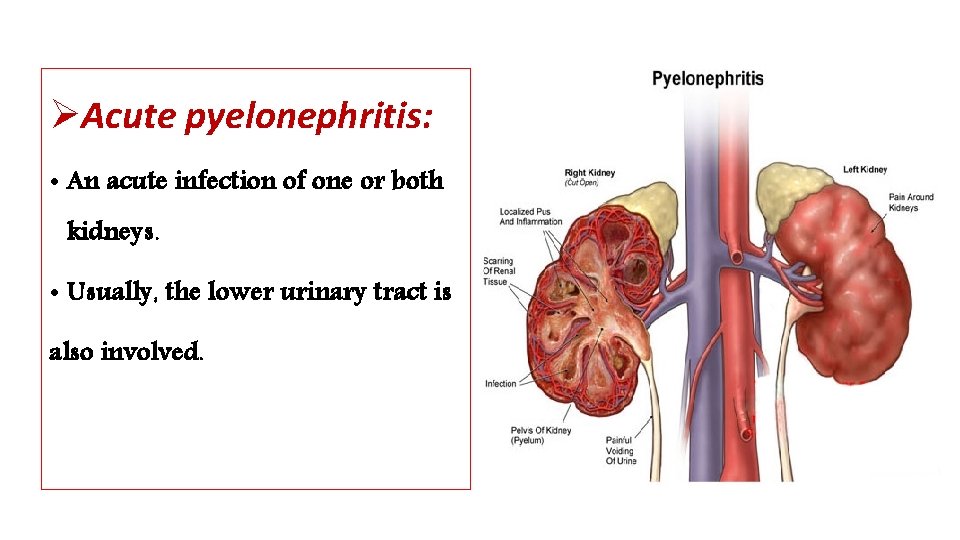 ØAcute pyelonephritis: • An acute infection of one or both kidneys. • Usually, the